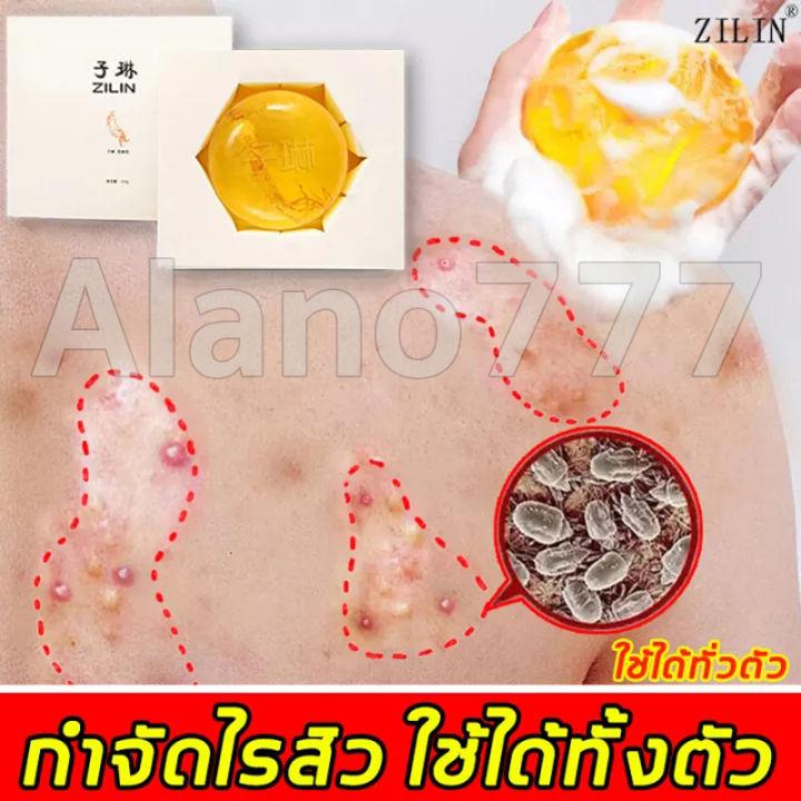 ZILIN สบู่กำจัดไร 100g สบู่กำจัดไรสิว สบู่กำจัดสิว สบู่ลดสิวหน้า ไวท์เทนนิ่ง สบู่สูตรลับโสม สบู่อาบน้ำ สบู่ล้างเครื่องสำอางค์ สบู่หน้าเงา สบู่ก้อน สบู่ล้างหน้า สบู่ป้องกันแบคทีเรีย สบู่น้ำผึ้งทอง สบู่รักษาสิว สบู่ลดสิวหลัง