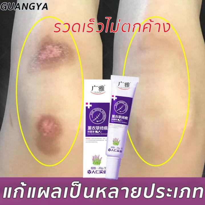 【ผลลัพธ์ที่รวดเร็ว】ครีมลบแผลเป็น 20g ครีมลดรอยแผลเป็นลดแผลไฟไหม้แผลน้ำร้อนลวกแผลผ่าตัดเป็นต้นแผลเป็นหลายประเภทยาลบลอยแผลเป็นครีมลดแผลเป็น ครีมลบรอยแผลดำ ครีมกำจัดแผลเป็นครีมลดรอยสิว รอยแผลเป็น แผลเป็น ครีมรักษาแผลเป็น เจลลบรอยแผลเป็น Scar cream