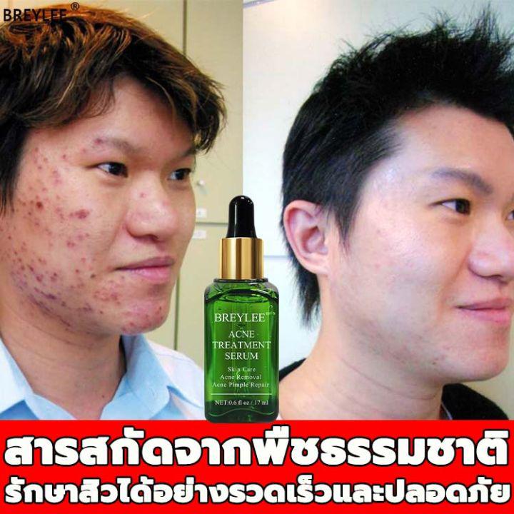 BREYLEE ครีมลดสิว 17ml ที่กดสิว ทำความสะอาดอย่างล้ำลึกผิวเรียบเนียน  ครีมรักษาสิว กำจัดสีว สิวผด ไม่มีหัว ลอกสิวเสี้ยน ผิวใสบริ๊งค์ ครีมกำจัดสิว เจลรักษาสิว สิวอุดตัน หลุมสิว ป้องกันสิว เซรั่มรักษาสิ ซ่อมแซมรอยสิว ลบรอยสิว กำจัดสิวหัวด Acne Essence