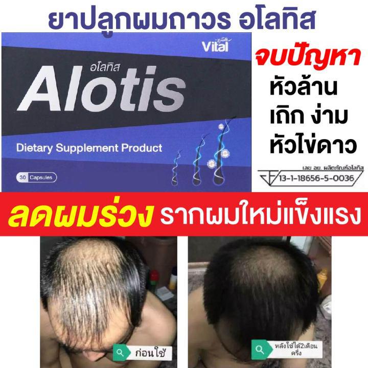 Alotis ยาปลูกผม ลดผมร่วง ผมบาง ผมหงอก หัวเถิก ผมดกดำ อโลทิส ผลิตภัณฑ์เสริมอาหารบำรุงเส้นผม เห็นผลจริง ชนิดเม็ด (30 แคปซูล)