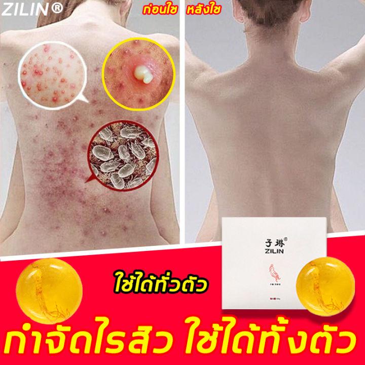 ZILIN สบู่ป้องกันแบคทีเรีย 100g สบู่ควบคุมความมัน สบู่สูตรลับโสม ​สบู่สูตรลับ ป้องกันผิวมัน เหมาะสำหรับผิวที่มีปัญหาสิว สบู่ลดสิวหน้า สบู่หน้าขาวใส สบู่กำจัดไร สบู่ล้างหน้า สบู่ฆ่าเชื้อ สบู่รักษาสิว สบู่ลดสิวหลัง สบู่รักษาสิวที่หลัง