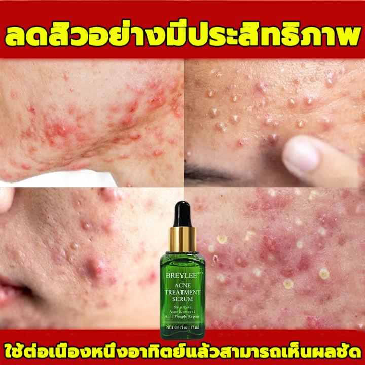 BREYLEE ครีมลดสิว 17ml ที่กดสิว ครีมรักษาสิว ครีมลดสิว ครีมกำจัดสิว เจลแต้มสิว เจลรักษาสิว  สิวอุดตัน หลุมสิว ป้องกันสิว ลบรอยแผลเป็นจากสิว เซรั่มรักษาสิว ซ่อมแซมรอยสิว ทำความสะอาดอย่างล้ำลึก ผิวเรียบเนียน ลบรอยสิว กำจัดสิวหัวดำ Acne Essence