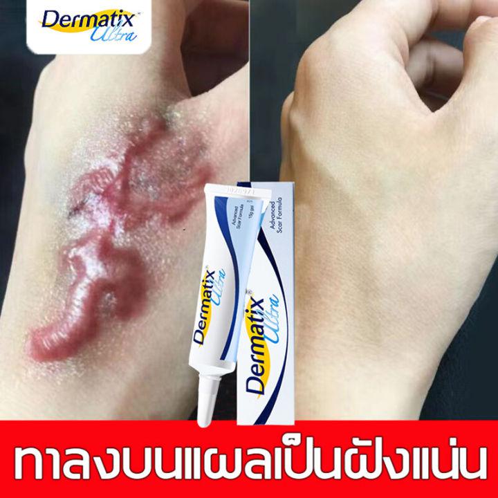 Dermatix Ultra Gel 15g ครีมลบแผลเป็น เจลซ่อมแซม เจลลบรอยแผลเป็น ลบรอยแผลเป็น ลดรอยแผลเป็น แผลผ่าตัด น้ำร้อนลวก ครีมทาแผลเป็น ครีมลบร